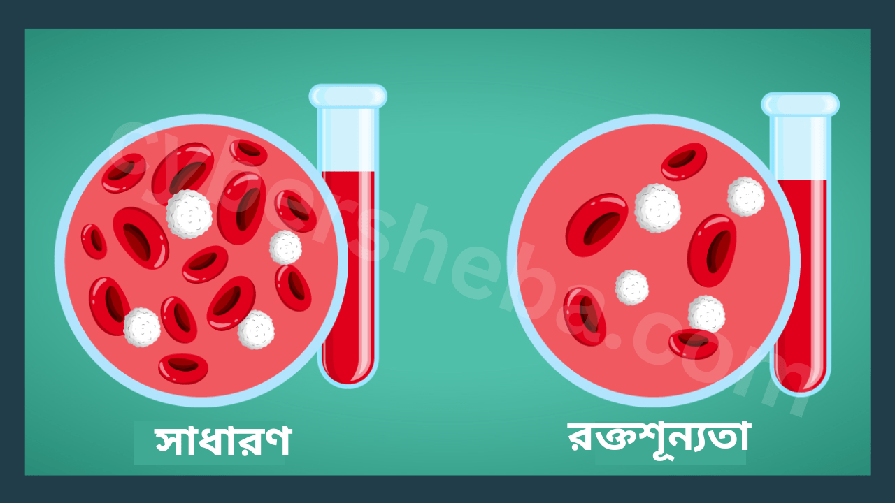 রক্তশূন্যতা দূর করুন ঘরোয়া উপায়ে-Anemia-cybersheba.com